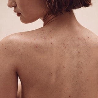 Body Acne